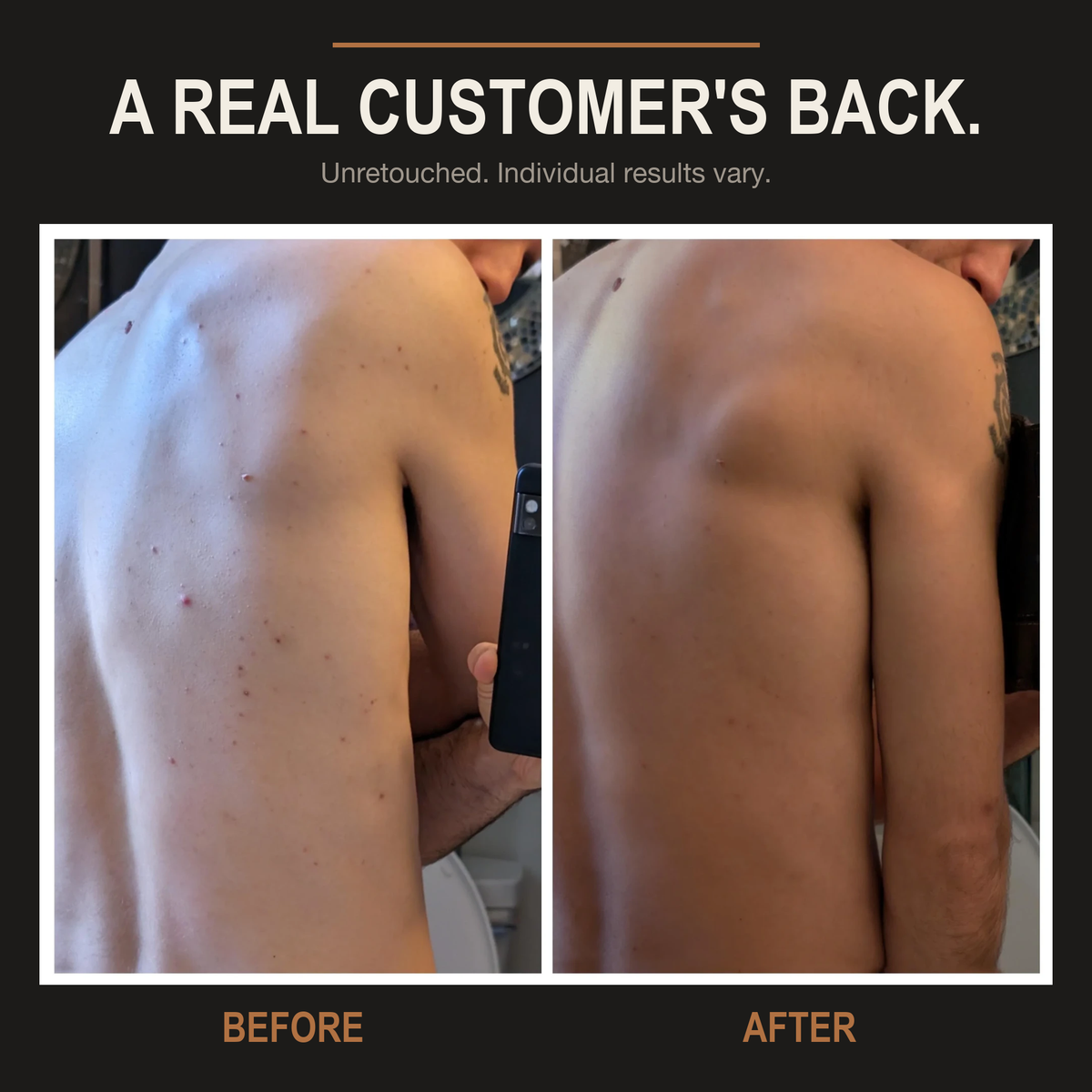 Multi-Acid Acne Body Wash