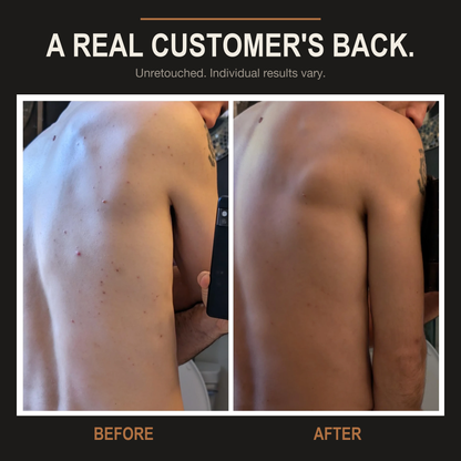 Multi-Acid Acne Body Wash